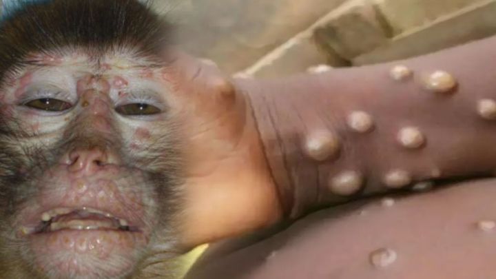 Elmlər doktoru: “Meymun çiçəyi” virusunun epidemiya olma ehtimalı yüksəkdir”